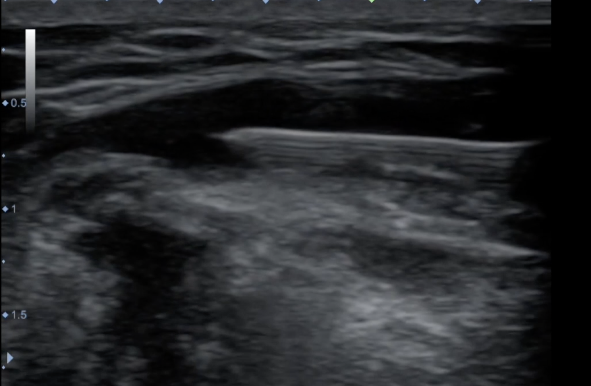 Lateral Epicondylitis