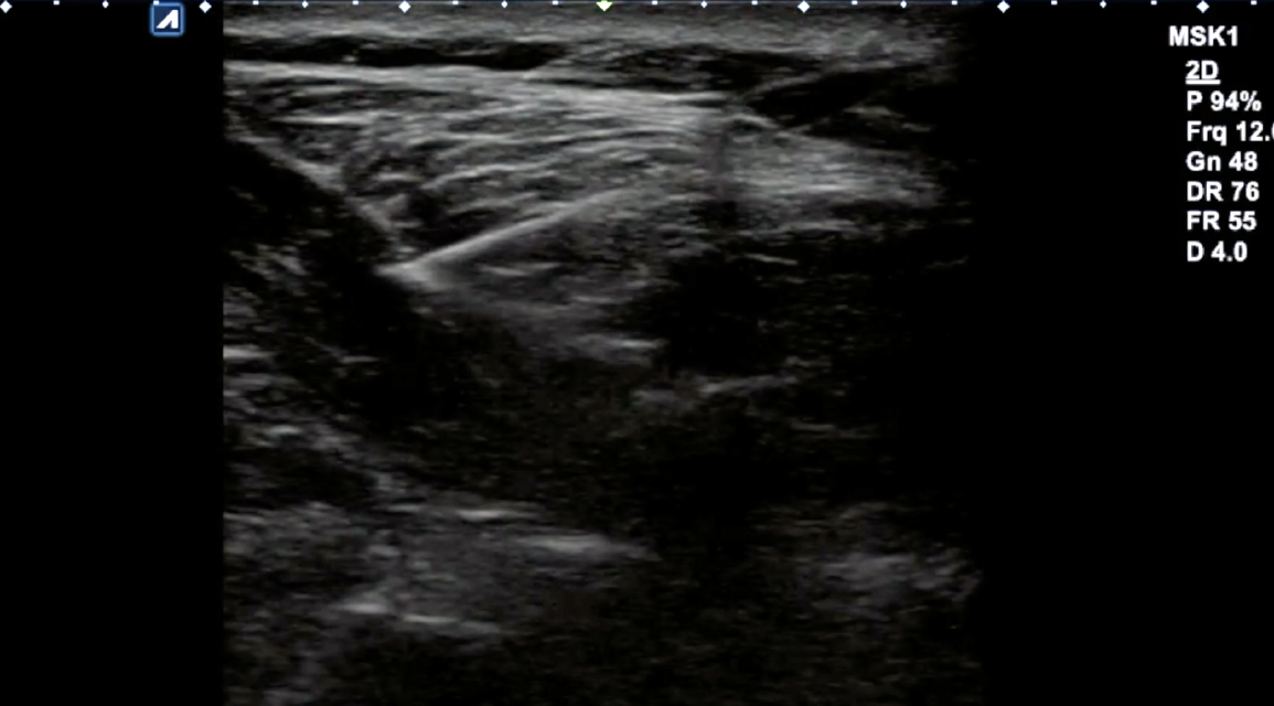 Spinal Accessory Nerve